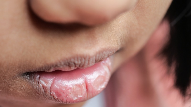 lippen zijn kwetsbaar